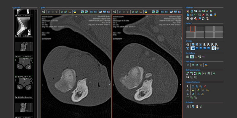 CT prä und post Ellenbogen FCP Operation